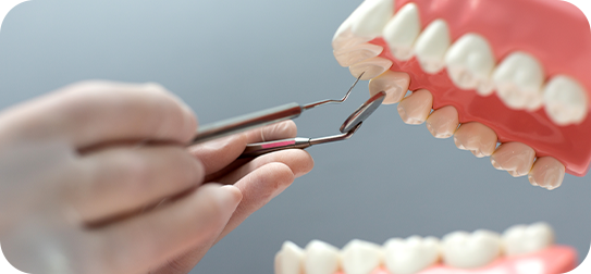 Dental bridge treatment