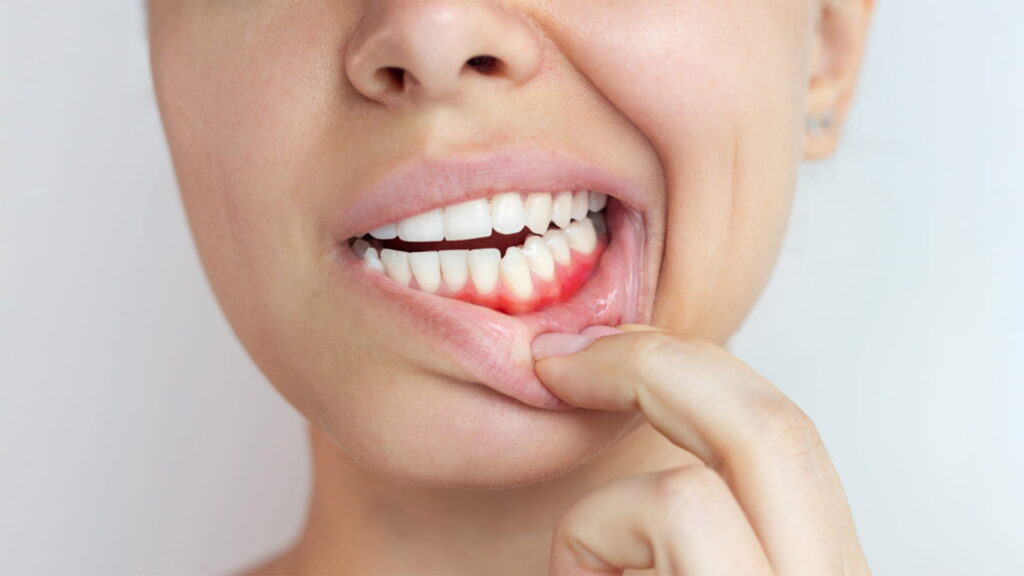 A close-up photograph of a person pulling down their lower lip with one finger to expose their lower gums and teeth.