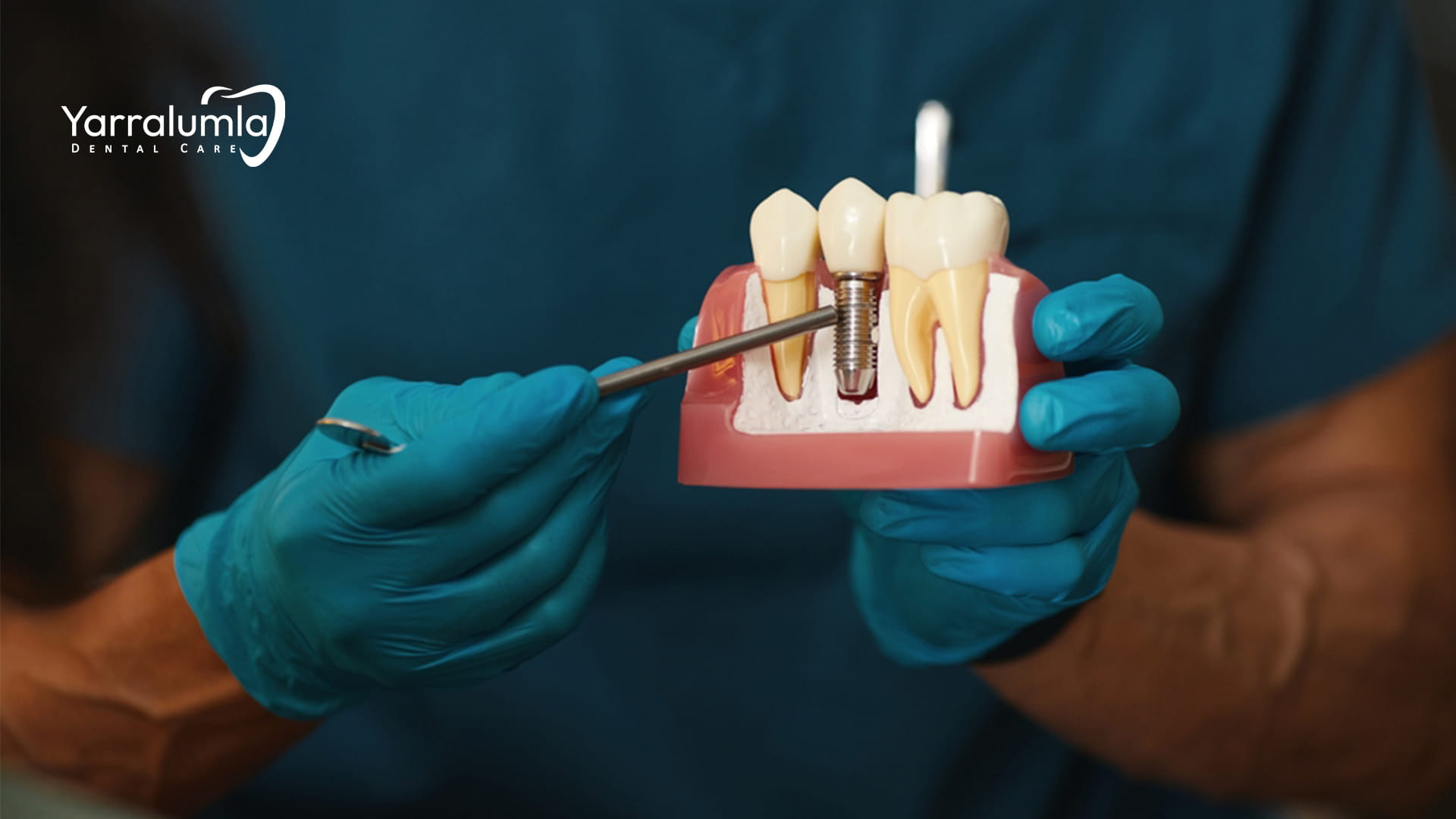 Dentist holding dental implant model showing implant placement process 