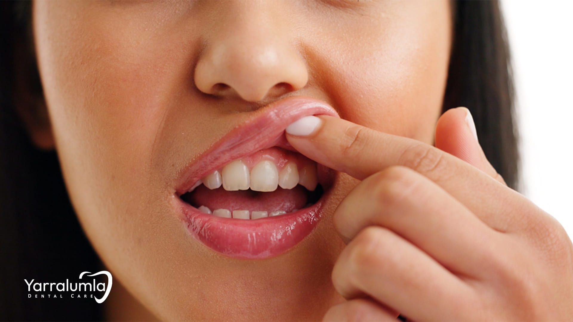 Close-up of woman pointing to swollen gum illustrating gum health issue 
